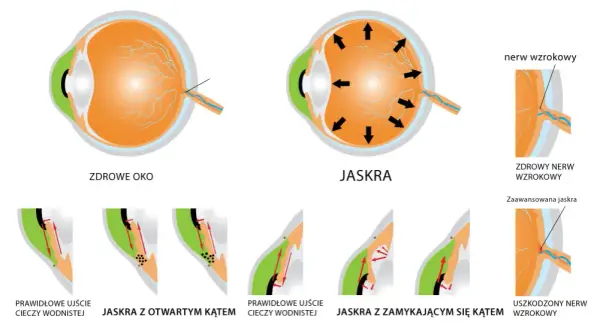 Co to jest jaskra? Poznaj objawy i skutki tej groźnej choroby