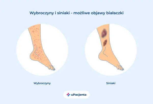 Wybroczyny i siniaki na nogach mogą być objawami białaczki szpikowej. Ilustracja pokazuje zmiany skórne.