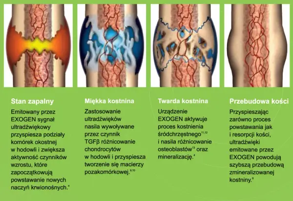 Ilustracje pokazują etapy gojenia kości: stan zapalny, miękką i twardą kostninę, a na końcu przebudowę kości. Proces ten, dzięki EXOGEN, przyspiesza tworzenie nowej tkanki kostnej, redukując problem **łamliwości kości**.
