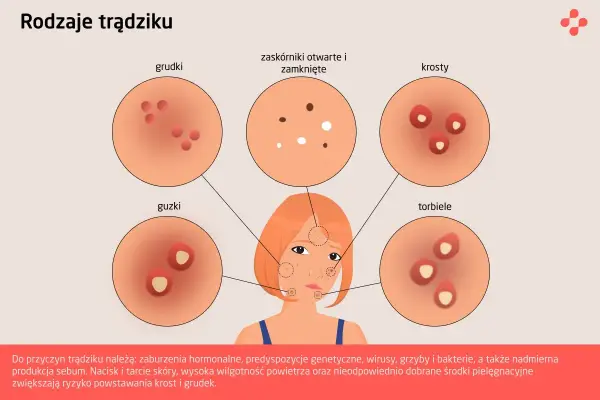 Ilustracja pokazuje różne rodzaje trądziku: grudki, zaskórniki, krosty, guzki i torbiele.