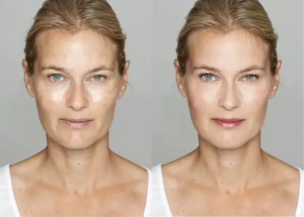 Ile kosztuje botox na czoło? Ceny w Polsce i co warto wiedzieć