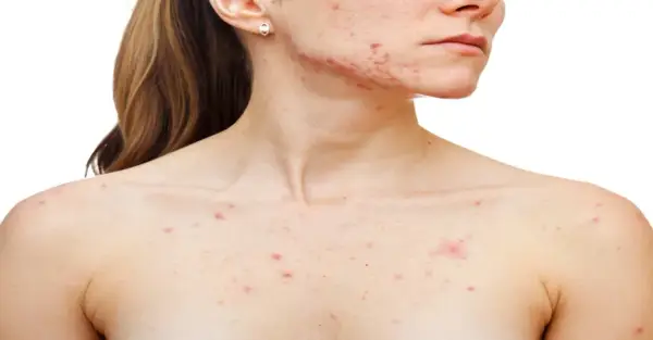 Persona con granos en el pecho y rostro, mostrando la afectación de la piel por acné.