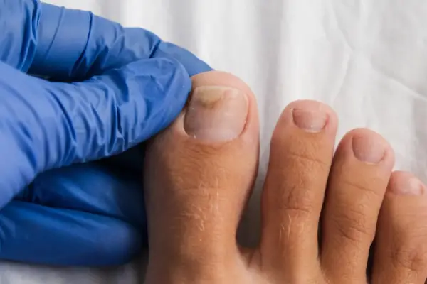 Main d'un podologue examinant un ongle de pied atteint de mycose. Renseignez-vous sur le tarif podologue mycose pour un traitement.