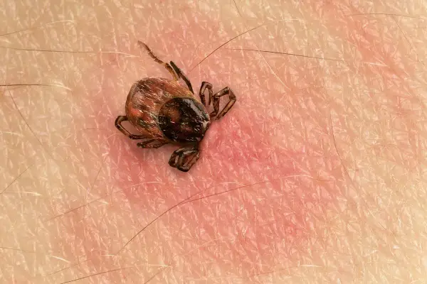 Makro zbliżenie na kleszcza przyczepionego do ludzkiej skóry. Widać jego nogi i odwłok.