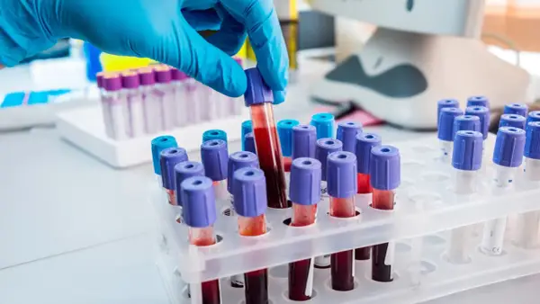 Ręka w niebieskiej rękawiczce pobiera probówkę z krwią. W tle stojaki z próbkami, sprzęt laboratoryjny. To ważny etap w badaniach arhd+.