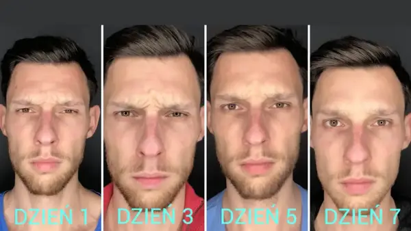 Kiedy efekty po botoksie? Od 2 dni do 6 miesięcy pełen harmonogram