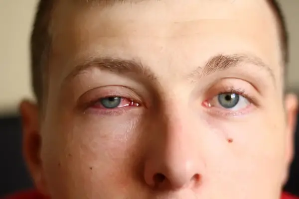 Œil rouge et irrité, signe de conjonctivite. Que faire pour soulager cette gêne ?