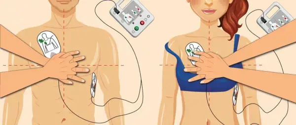 Instrukcja użycia AED: elektrody przyłożone do klatki piersiowej, urządzenie analizuje rytm serca, by wykryć migotanie komór.