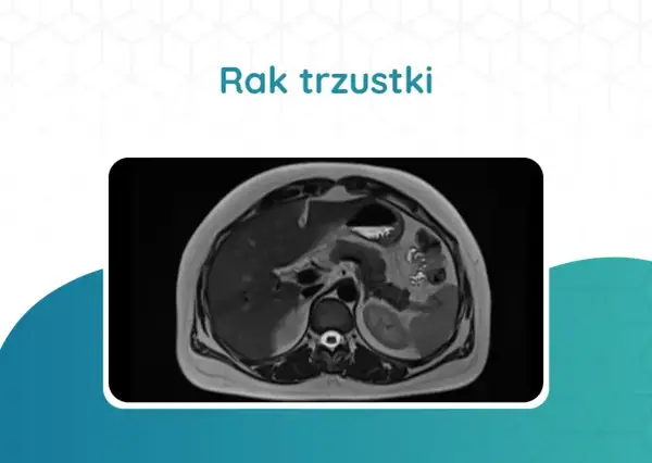 Tomografia rezonansu magnetycznego jamy brzusznej, ukazująca obraz raka trzustki. Jakie badania na trzustkę są kluczowe w diagnostyce.