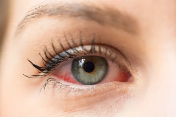 Rotes, gereiztes Auge mit sichtbaren Äderchen. Vielleicht ein Fall für Bindehautentzündung Hausmittel?
