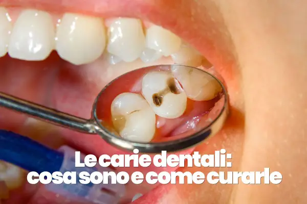 Denti con evidenti carie visibili nello specchietto del dentista.