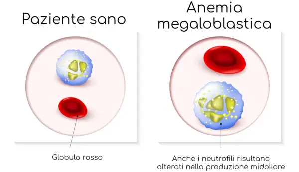 Confronto tra globuli rossi e neutrofili di un paziente sano e uno con anemia megaloblastica, dove i neutrofili appaiono alterati.