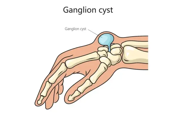 Przekrój dłoni ukazujący kości i ganglion.