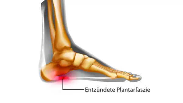 Entzündete Plantarfaszie im Fuß, die Schmerzen verursacht. Die Plantarfasziitis wird immer schlimmer.
