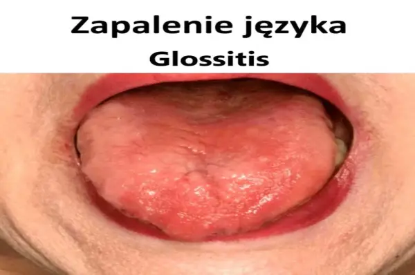 Zapalenie języka - Leki bez recepty i kiedy do lekarza?