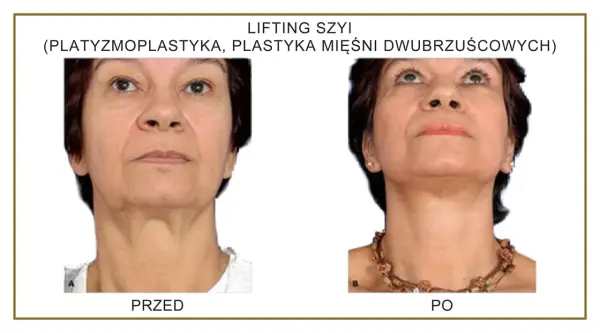 Lifting szyi - operacja, botoks czy nici? Sprawdź, co naprawdę działa