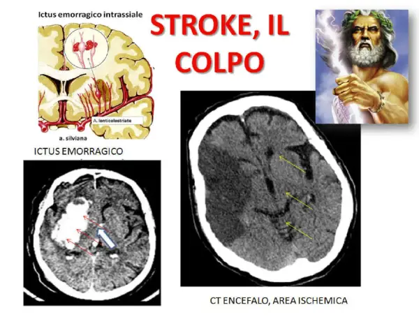 Immagini mediche mostrano ictus cerebrali, emorragici e ischemici. La vasculopatia cerebrale cronica può influenzare l'aspettativa di vita.