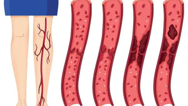 Illustration zeigt gesunde Wade und Blutgefäße mit zunehmender Thrombosebildung. Ein Thrombose Test Wade kann dies aufzeigen.