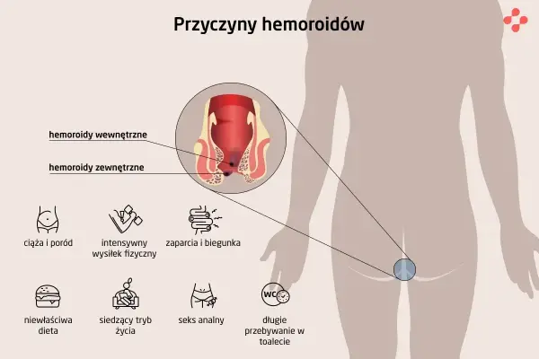 Ilustracja przedstawia przyczyny hemoroidów: ciąża, wysiłek fizyczny, zaparcia, dieta, siedzący tryb życia, seks analny, długie przebywanie w toalecie.