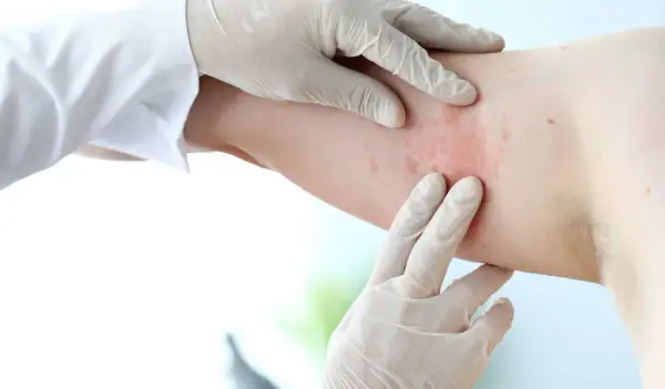 Alergia na chemikalia objawy: poznaj niebezpieczne reakcje i objawy