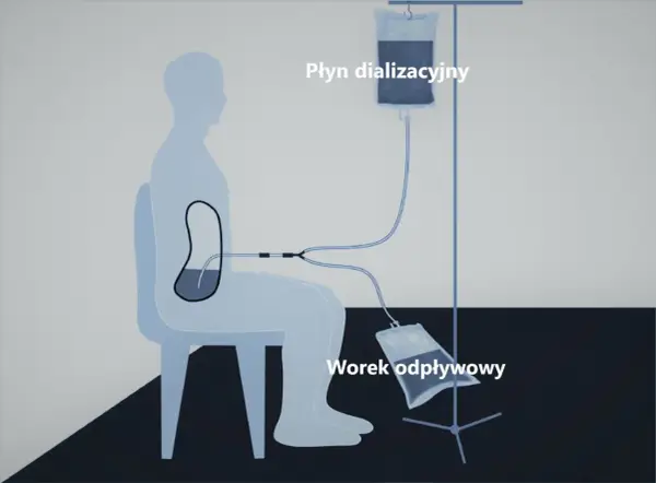 Schemat dializy otrzewnowej: cewnik Tenckhoffa w jamie otrzewnej pacjenta, podłączony do worka z płynem dializacyjnym i worka odpływowego.