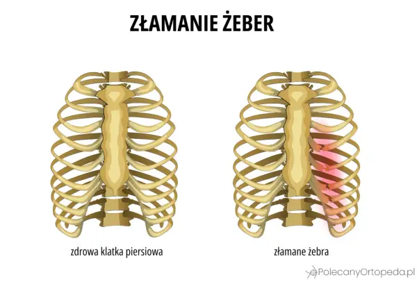 Porównanie zdrowej klatki piersiowej z tą, gdzie widoczne są stłuczone żebra bez siniaka, zaznaczone czerwonym rumieńcem.