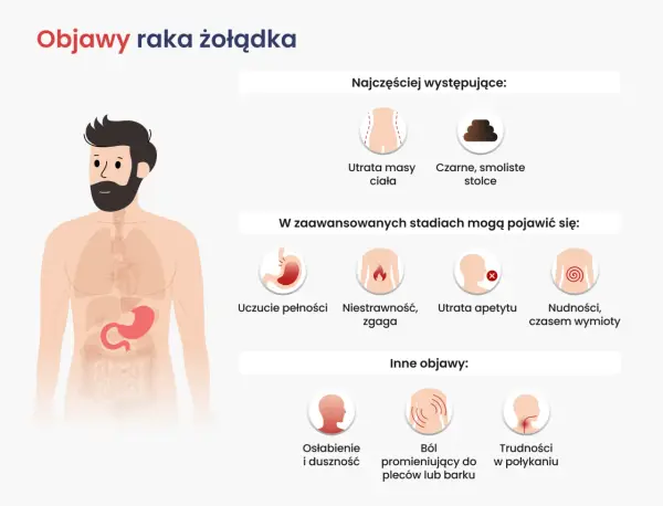 Objawy raka żołądka: utrata masy, czarne stolce, uczucie pełności, niestrawność, zgaga, utrata apetytu, nudności, wymioty, osłabienie, duszność, ból pleców, trudności w połykaniu. Czy rak żołądka boli? Tak, może powodować ból.