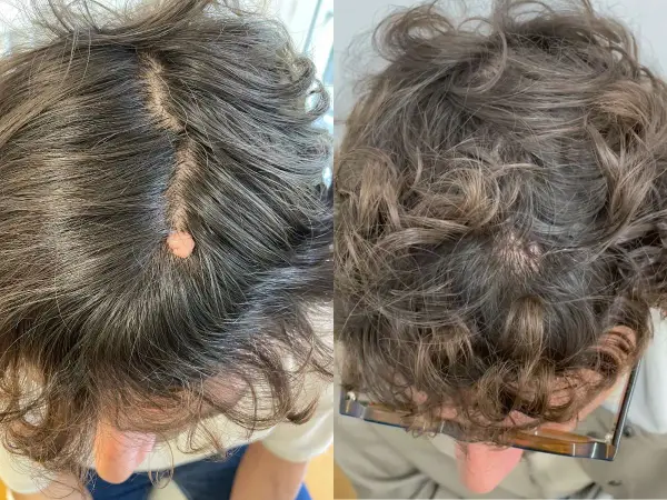 Comparación de verrugas en la cabeza antes y después del tratamiento.