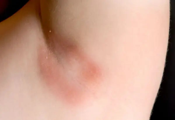 Czerwone plamy pod pachami, zaczerwienienie skóry w okolicy pachy, możliwe podrażnienie.