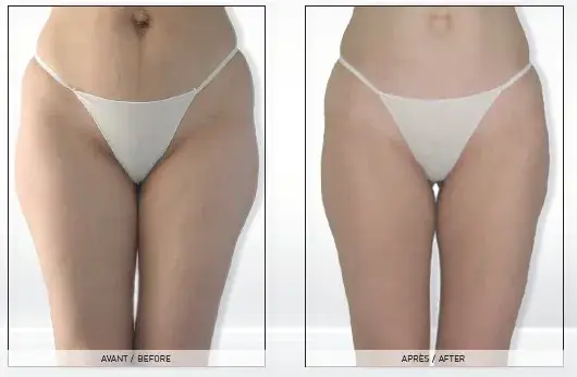 Endermologia: Gładka skóra i wymodelowana sylwetka bez skalpela?