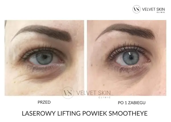 Laser na powieki - Resurfacing czy plastyka? Wybierz mądrze!