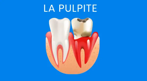 Dente sano e dente cariato con gengive infiammate. Illustrazione sulla pulpite, suggerendo la necessità di rimedi per il nervo dente infiammato.