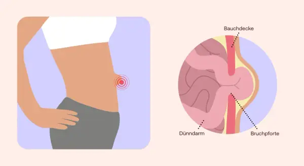 Illustration zeigt einen Bauch mit einem roten Schmerzpunkt und eine Nahaufnahme eines Nabelbruchs, der Dünndarm durch die Bauchdecke drückt. Nabelbruch Symptome.