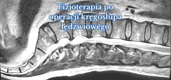 Czy fizjoterapia pomaga na kręgosłup? Odkryj skuteczne metody leczenia