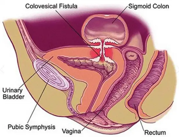 Anatomical diagram showing a colovesical fistula, a connection between the colon and bladder.