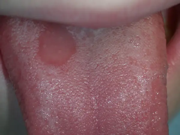 Lingua con afte, un sintomo comune nella celiachia. Le papille gustative appaiono gonfie e irritate.