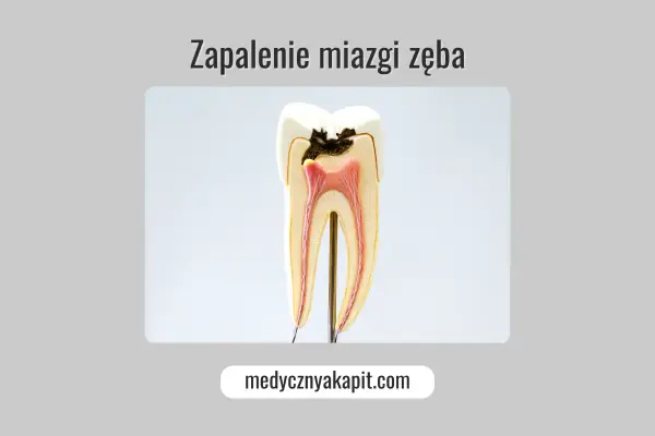 Model zęba ukazujący próchnicę sięgającą miazgi, co prowadzi do zapalenia miazgi.
