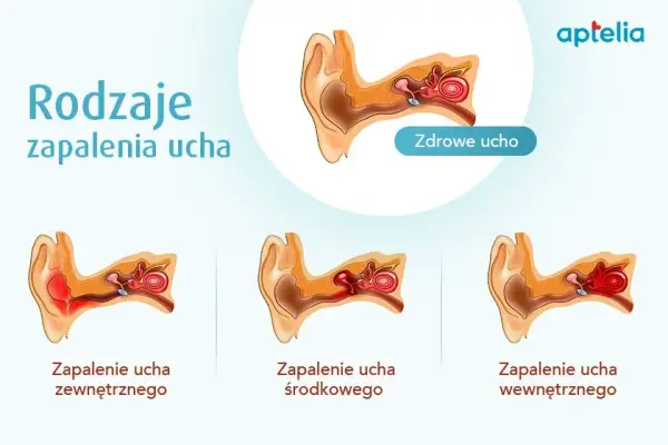 Co na ból ucha u dziecka forum: skuteczne sposoby i porady rodziców