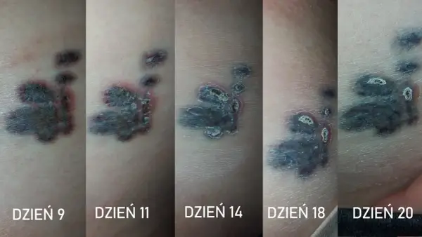 Czy antybiotyk po tatuażu szkodzi? Wszystko o bezpieczeństwie i gojeniu