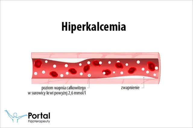 Podwyższony Wapń (Hiperkalcemia): Przyczyny, Objawy i Leczenie