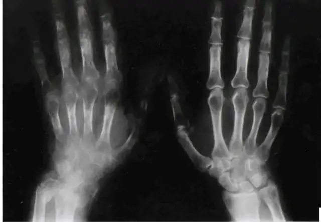 RTG dłoni ukazujący zmiany kostne charakterystyczne dla zespołu sudeckiego. Widoczne są objawy osteoporozy, obrzęki i zwężenia przestrzeni stawowych.