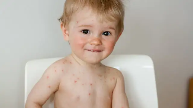 Czy dziecko ze strupami po ospie może iść do przedszkola? Fakty