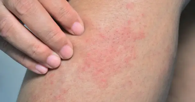 Dłoń dotyka skóry z widocznymi, swędzącymi czerwonymi plamami na ciele, które mogą wskazywać na alergię lub podrażnienie.