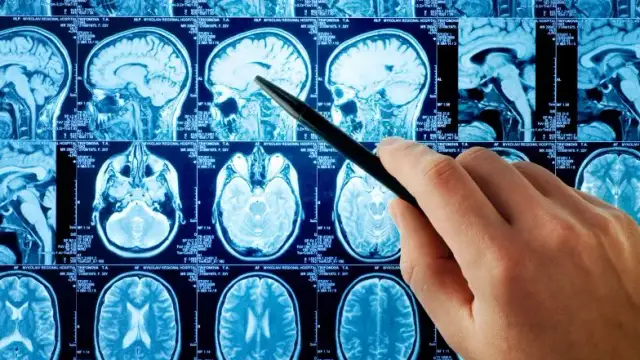 Rezonans magnetyczny a choroby psychiczne: co naprawdę wykryje MRI?