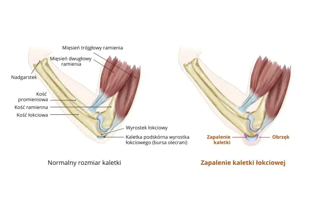 Porównanie zdrowej kaletki łokciowej z jej zapaleniem i obrzękiem.