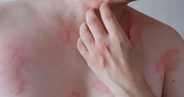 Czy pietruszka uczula? Objawy alergii, które warto znać