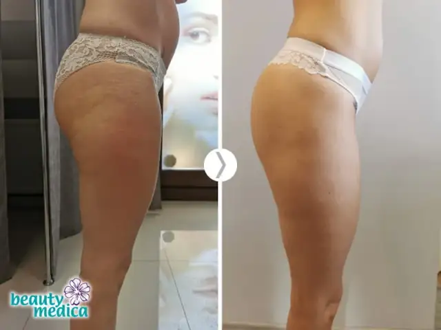 Endermologia: Hit czy Kit? Obiektywna Analiza Efektów i Kosztów