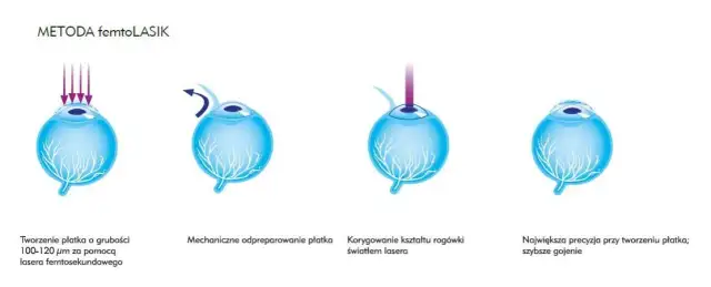 Korekcja krótkowzroczności: Od okularów po laser wybierz mądrze!