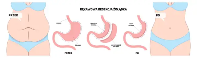 Operacja zmniejszenia żołądka na NFZ - gdzie i jak się kwalifikować
