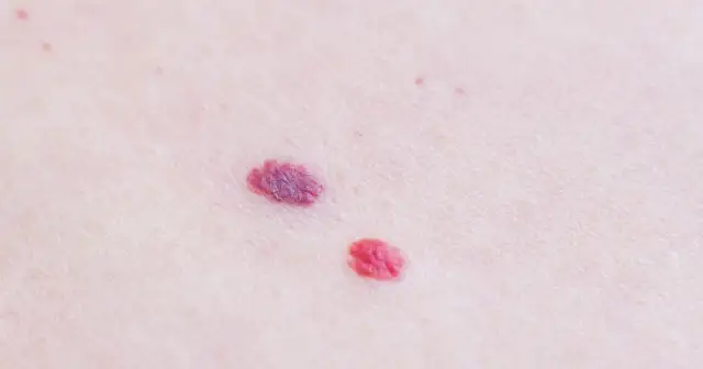 Dwa małe, czerwone znamiona na skórze. Jedno z nich ma wyraźne zaczerwienienie wokół pieprzyka, przypominające mały, purpurowy kwiat.